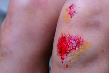 A woman falls and scratches her knee from running.