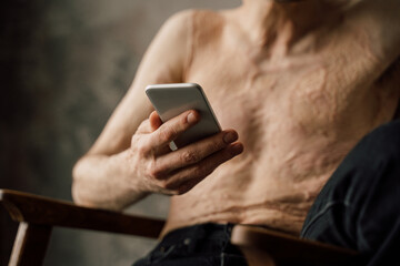 Cropped view of the young man with scars after burn holding cell phone and playing at mobile games