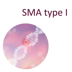 SMA type I. Spinal muscular atrophy. Genetic. DNA double helix. Medical illustration.