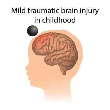 TBI. Mild Traumatic Brain Injury In Childhood. Kid, Child Head Damage.