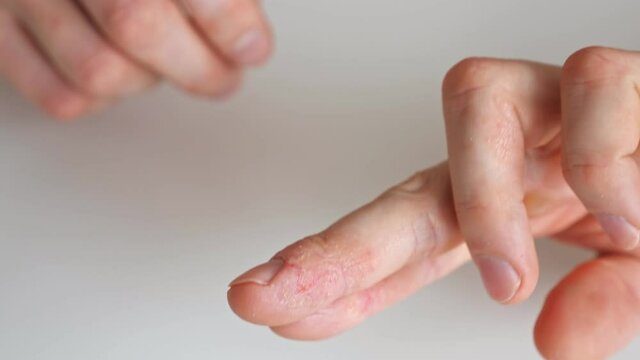 Fingers of a man with psoriasis and eczema close-up.