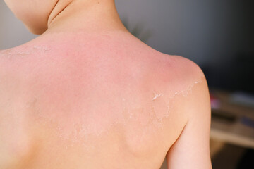 back of a child with sunburns and peeling dead skin of a 6-7 year old boy with sunscreen, body hygiene concept, sunburn