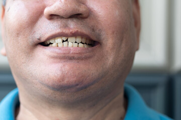 old man woth crooked teeth, concept of oral health care, tooth cavity