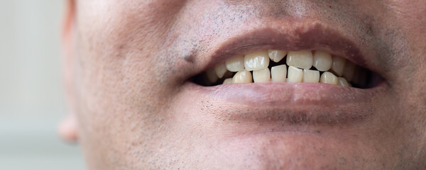 old man woth crooked teeth, concept of oral health care, tooth cavity