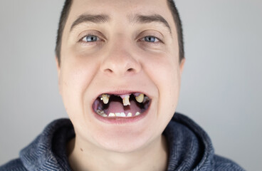 The man has rotten teeth, teeth fell out, yellow and black teeth hurt. Poor teeth condition,...