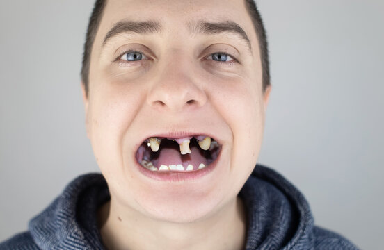 The man has rotten teeth, teeth fell out, yellow and black teeth hurt. Poor teeth condition, erosion, caries. The doctor prepares the patient for treatment