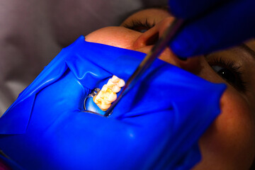 Treatment of the upper sixth left tooth, sterile treatment with roofing felt.