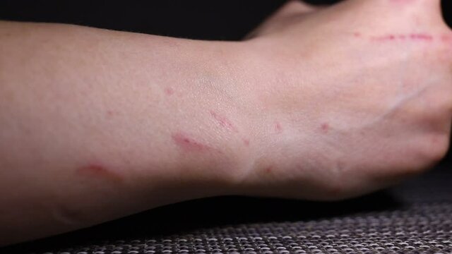 Close-up of scratch marks on a woman hand, fresh cat scratches, damaged skin