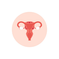 Female reproductive system with adenomyosis, enlarged uterus icon. Flat vector cartoon modern illustration. 
