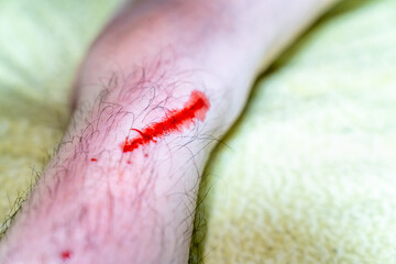 足から出血している男性の写真