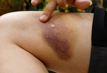 Fototapeta premium Hematoma and Large Bruise, blood under skin Congestion