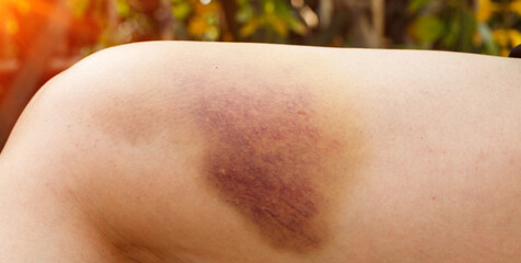 Hematoma and Large Bruise, blood under skin Congestion