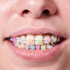 Close up snapshot of beautiful woman's smile, demonstrating white healthy teeth with ceramic braces, united with a wire and colorful rubber bands. Concept of dentistry and orthodontics