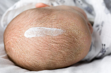 Seborrheic dermatitis on baby's head with cream on it. treatment of seborrhea crusts of newborn child