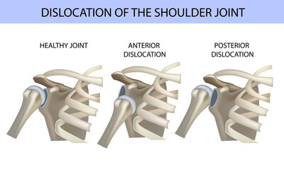 Dislocation of the shoulder joint, medical vector illustration