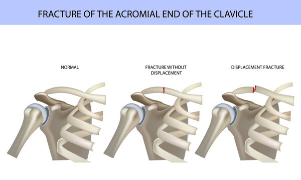 Fracture of the acromial end of the clavicle, medical vector illustration