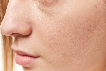 Acne on the girl's face. Photo close-up