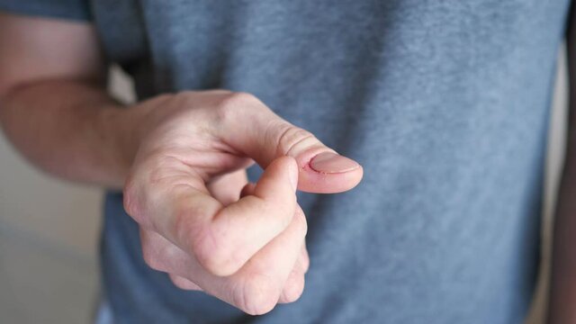 Man in grey t-shirt scratches agnail on finger suffering from neurosis on blurred beige background in light room extreme close crop view