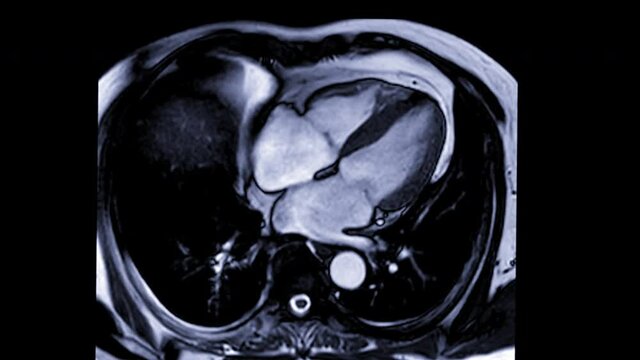 MRI heart or Cardiac MRI ( magnetic resonance imaging ) of heart in long axis view showing heart beating for detecting heart disease.
