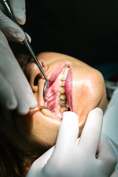 From above of crop anonymous dentist in gloves with professional tools examining teeth of patient with braces