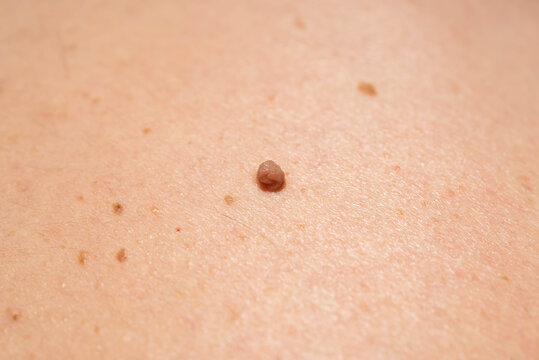 Skin tag or acrochordon or soft fibroma or mole in male back, macro view. Papilloma virus or bump, dermatology problem skin concept. 