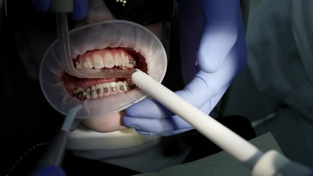 team of orthodontists are cleaning braces for teeth of client, closeup view