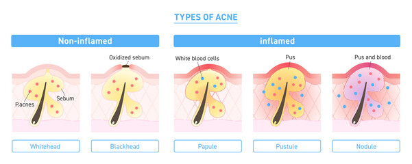 Illustration of types of acne with explanation