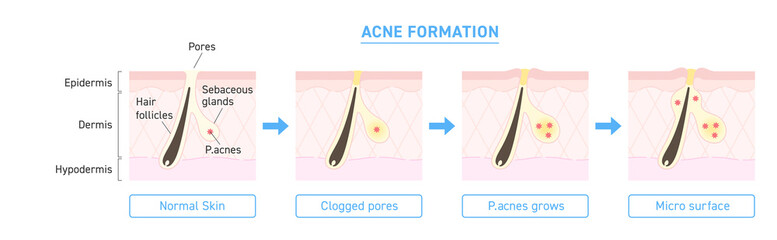 Illustration of acne formation with explanation