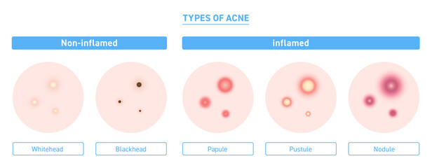 Illustration of types of acne with explanation
