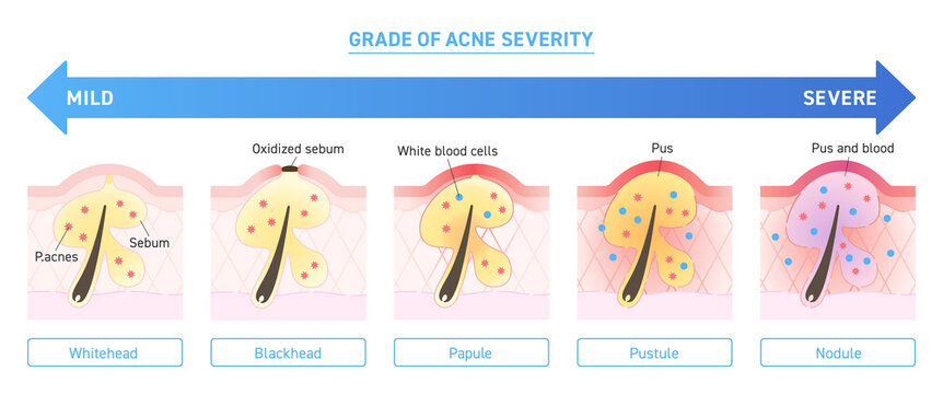 Illustration of grade of acne severity