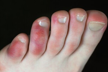Covid toes. Coronavirus symptoms - swelling and discoloration, purplish color, pain and rough skin.