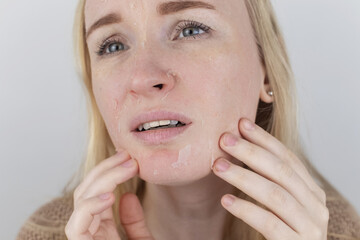 A woman examines dry skin on her face. Peeling, coarsening, discomfort, skin sensitivity. Patient at the appointment of a dermatologist or cosmetologist. Close-up of pieces of dry skin