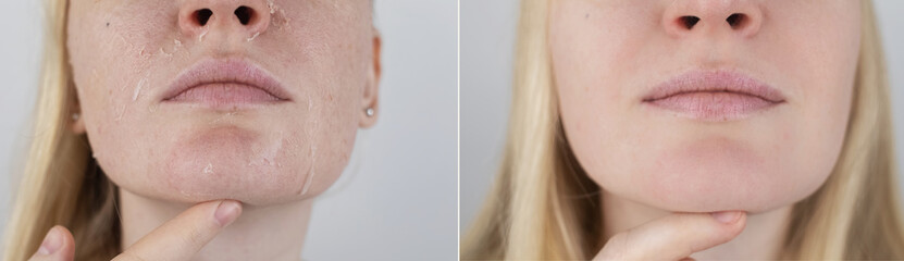 Before and after. A woman examines dry skin on her face. Peeling, coarsening, discomfort, skin...