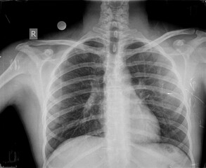 Chest xray images