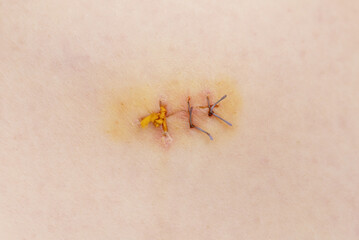 Stitched up skin after laparoscopic operation