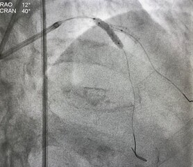Two non-compliance balloons (NC balloon) inflated after coronary stent deployed at left anterior...