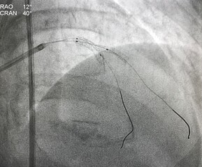 Two non-compliance balloons (NC balloon) inflated after coronary stent deployed at left anterior descending artery (LAD) and diagonal branch (DG). Kissing balloon technique. 