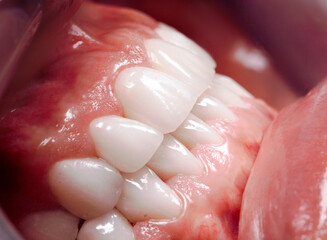 Perfect smile surgery veneers bleach of zircon arch ceramic prothesis Implants crowns. Dental restoration treatment clinic patient. Result of oral procedure whitening dentistry