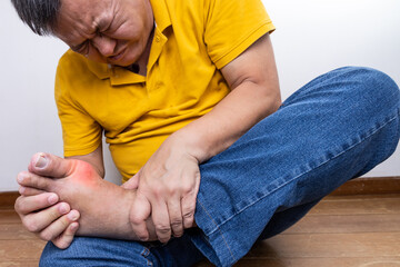 Asian man with hand embracing inflammed foot with painful gout