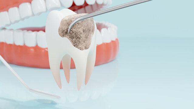 Dental care concept. Dental caries and calculi of teeth on a blue background. 3d render.