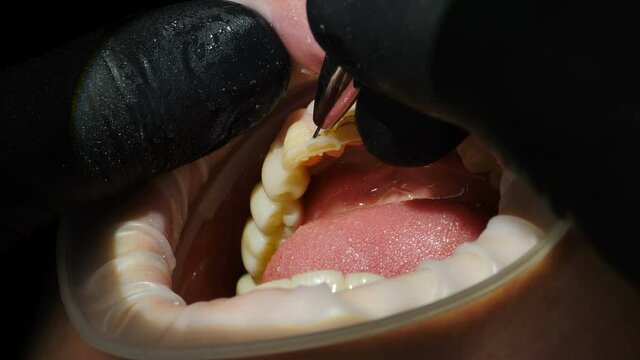 Process of veneers installing. Dentist marks with tool places for drilling. Female patient in chair having porcelain veneers installation procedure, Teeth getting ready for Cosmetic veneers. 4 k video