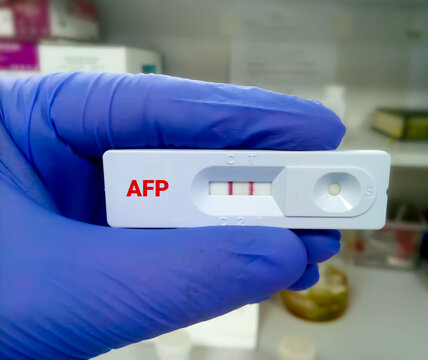Rapid diagnostic test for AFP test (liver cancer diagnosis) with a positive result. Rapid test cassette