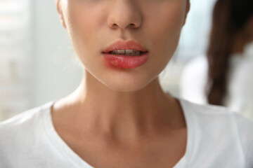 Woman with herpes on lip against blurred background, closeup - obrazy, fototapety, plakaty