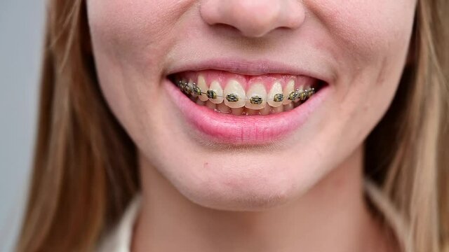 The unrecognizable red-haired girl smiles and runs her tongue over the braces. Young woman corrects bite with orthodontic appliance.