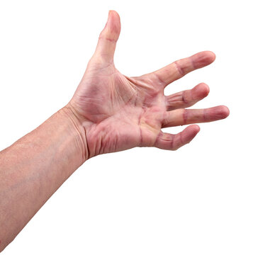 Hand of an man with Dupuytren contracture disease