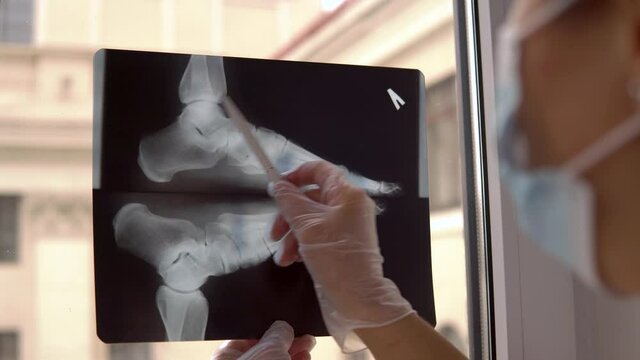 Doctor examines x-ray film of broken foot