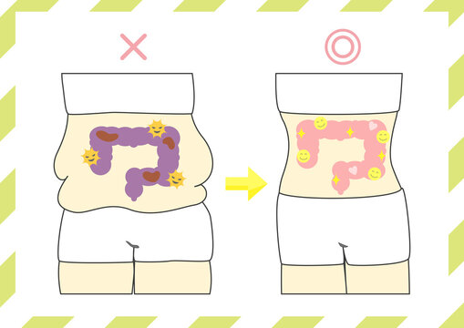 腸活のビフォー・アフター　善玉菌が多い腸　悪玉菌が多い腸