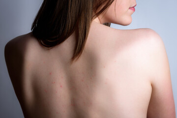 Female back with acne, red spots, pimples. Young girl with a magnifying glass on gray background....