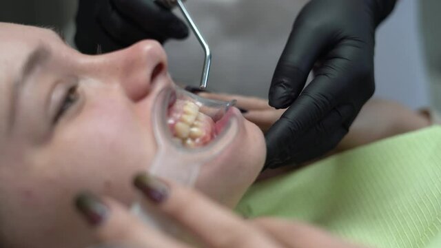 young beautiful caucasian lady at the dentist appointment. the dentist installs a labial retractor to the patient. side view. 4k