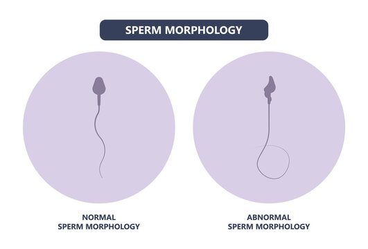 in vitro fertilization IVF semen test sample sperm count type Male biopsy fertility collect Low Poor Zero head anatomy midpiece tail birth control blocked defect abnormal ejaculate vas Non dry